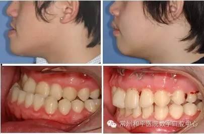 成人高颅顶矫正视频