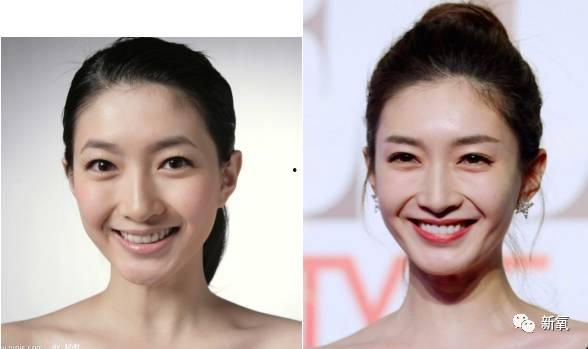 成人高颅顶矫正视频