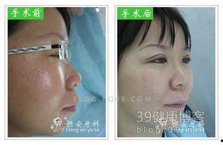 成人高颅顶矫正视频