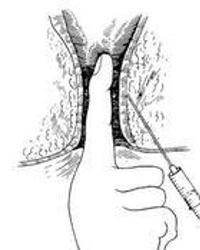 成人直肠注射教程视频,成人直肠注射操作教程视频概述