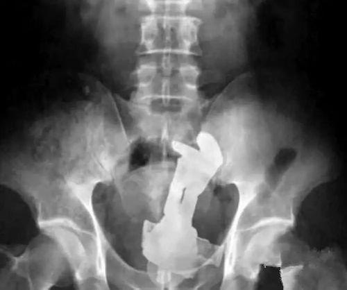 成人直肠注射教程视频,成人直肠注射操作教程视频概述