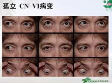 成人双眼复视训练视频,专业指导，轻松改善视力问题