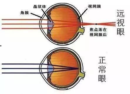成人远视能矫正嘛视频,揭秘视力恢复新途径  第3张